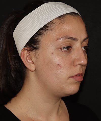 Facial Fat Grafting Before & After Gallery - Patient 169737561 - Image 4