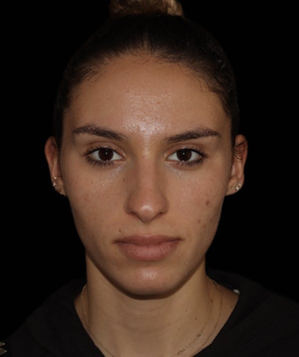 Rhinoplasty Before & After Gallery - Patient 122852435 - Image 3