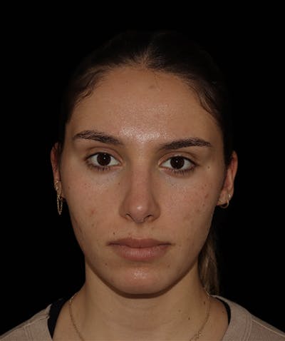 Rhinoplasty Before & After Gallery - Patient 122852435 - Image 4