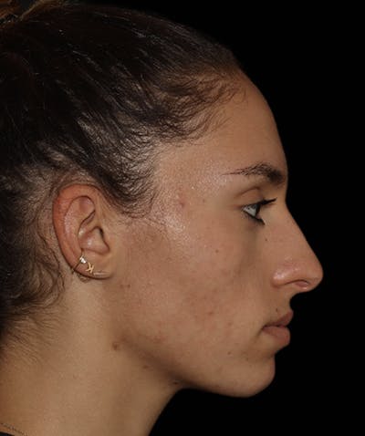 Rhinoplasty Before & After Gallery - Patient 122852435 - Image 1