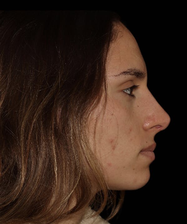 Rhinoplasty Before & After Gallery - Patient 122852435 - Image 2