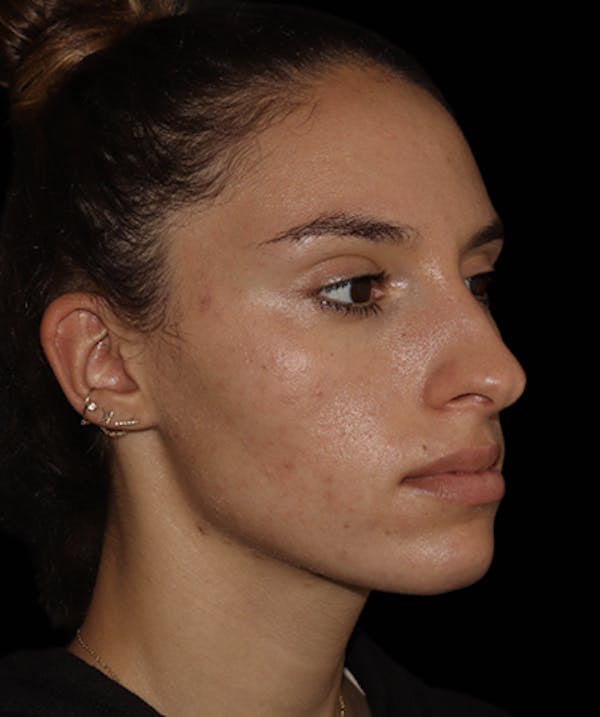 Rhinoplasty Before & After Gallery - Patient 122852435 - Image 5