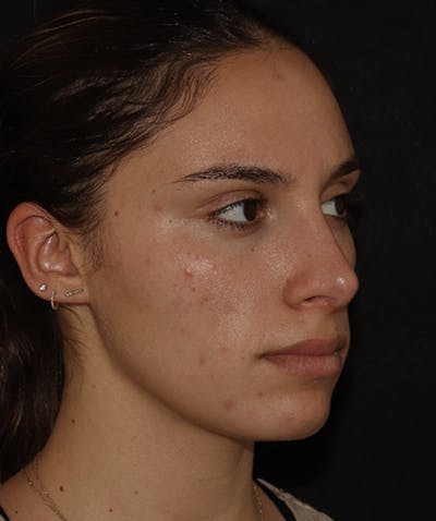 Rhinoplasty Before & After Gallery - Patient 122852435 - Image 6
