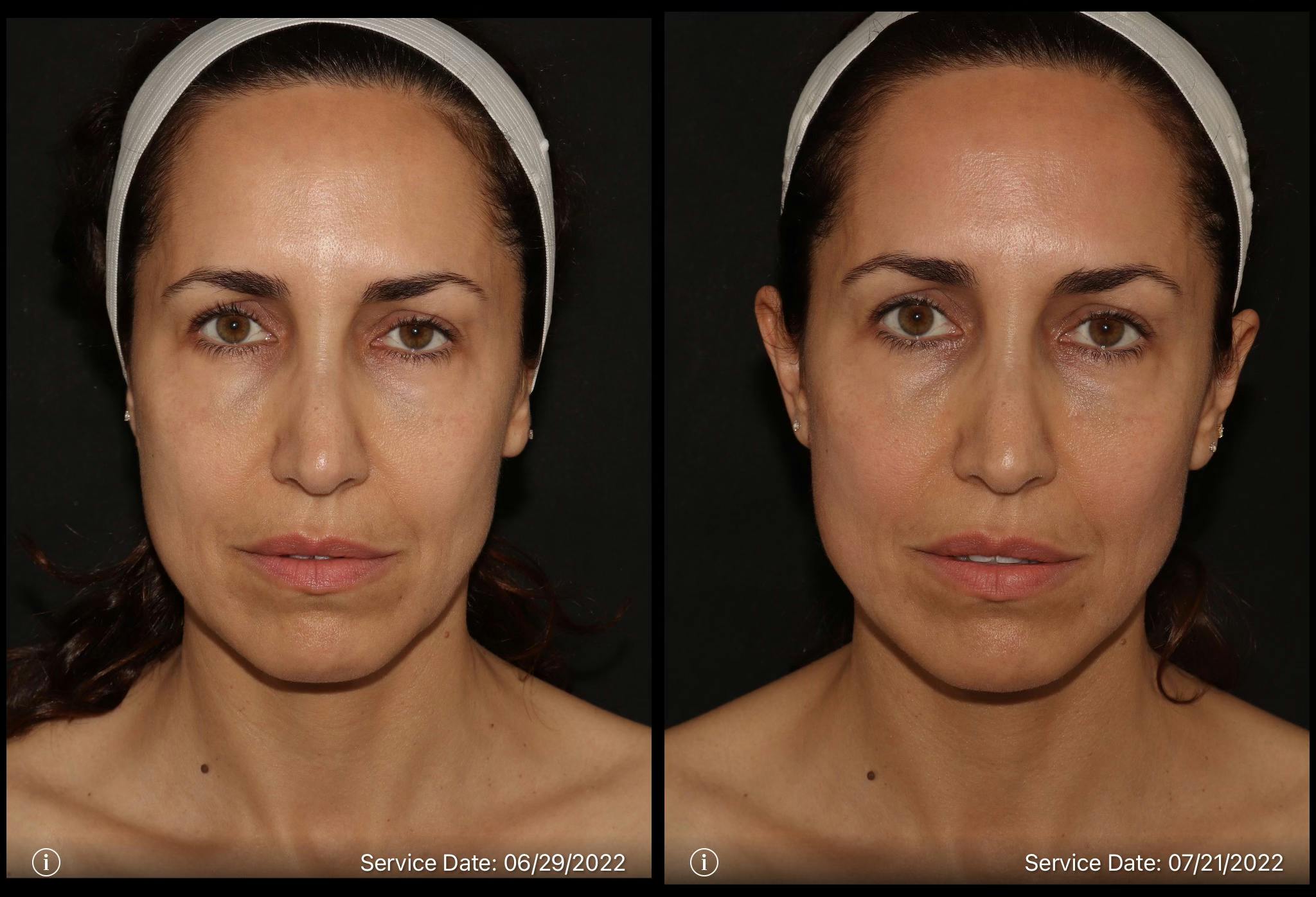 Before and after 