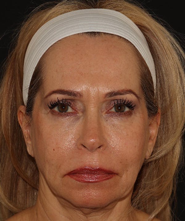 Facelift Before & After Gallery - Patient 141788588 - Image 1