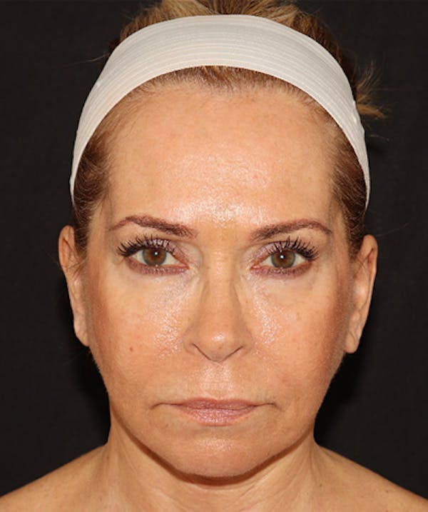 Facelift Before & After Gallery - Patient 141788588 - Image 2