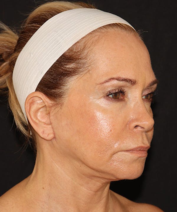 Facelift Before & After Gallery - Patient 141788588 - Image 4