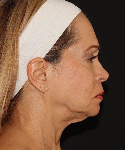 Facelift Before & After Gallery - Patient 141788588 - Image 5