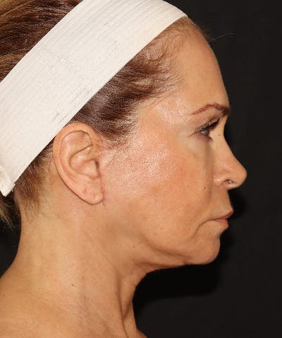 Facelift Before & After Gallery - Patient 141788588 - Image 6