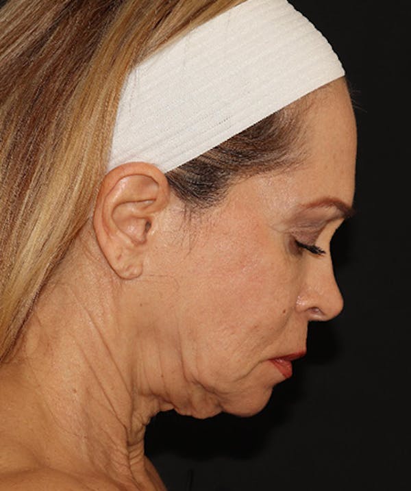 Facelift Before & After Gallery - Patient 141788588 - Image 7