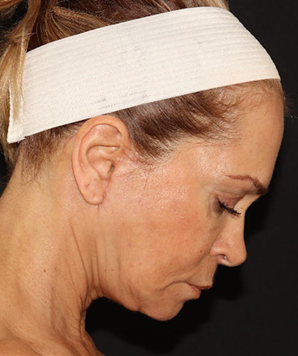 Facelift Before & After Gallery - Patient 141788588 - Image 8