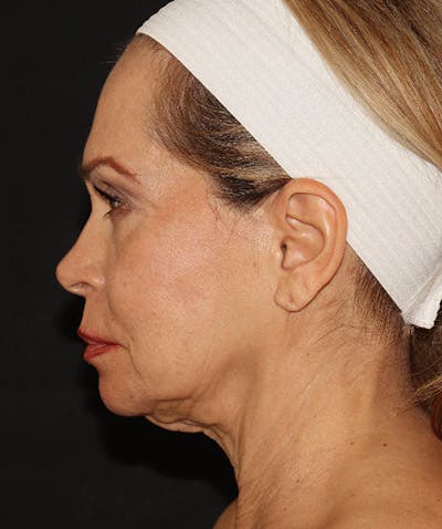 Facelift Before & After Gallery - Patient 141788588 - Image 9