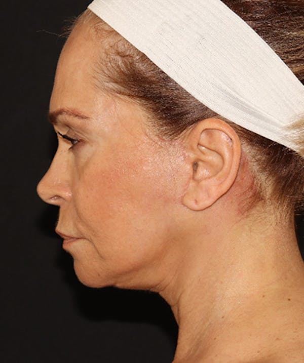 Facelift Before & After Gallery - Patient 141788588 - Image 10