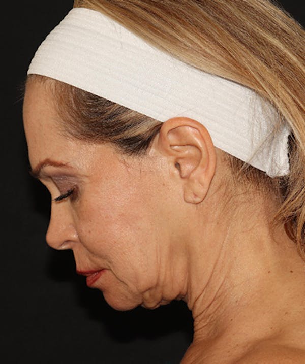 Facelift Before & After Gallery - Patient 141788588 - Image 11