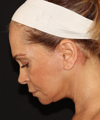 Facelift Before & After Gallery - Patient 141788588 - Image 12