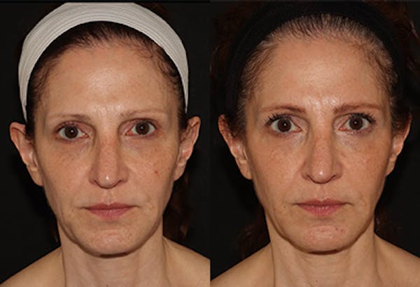 EMFACE Before & After Gallery - Patient 142786767 - Image 1
