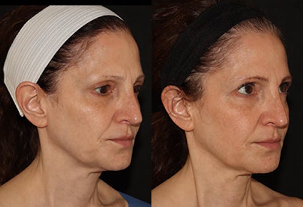 EMFACE Before & After Gallery - Patient 142786767 - Image 2