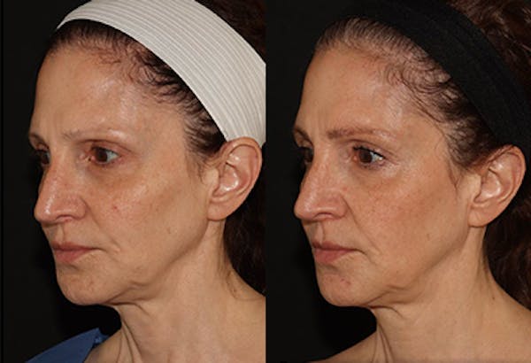 EMFACE Before & After Gallery - Patient 142786767 - Image 3
