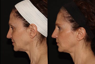 EMFACE Before & After Gallery - Patient 142786767 - Image 4
