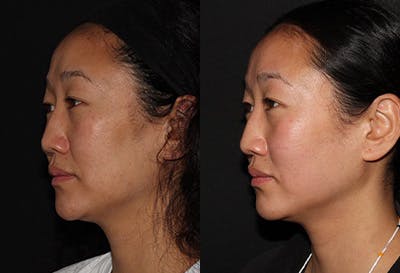 EMFACE Before & After Gallery - Patient 142786770 - Image 1