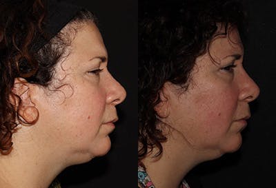 EMFACE Before & After Gallery - Patient 142786768 - Image 2