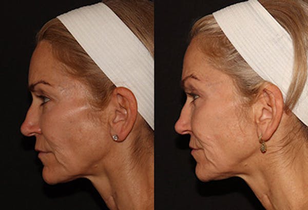 EMFACE Before & After Gallery - Patient 142786769 - Image 1