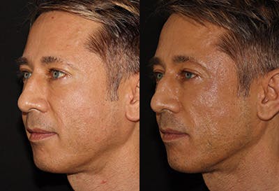 EMFACE Before & After Gallery - Patient 142786771 - Image 2