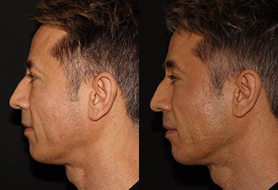 EMFACE Before & After Gallery - Patient 142786771 - Image 3