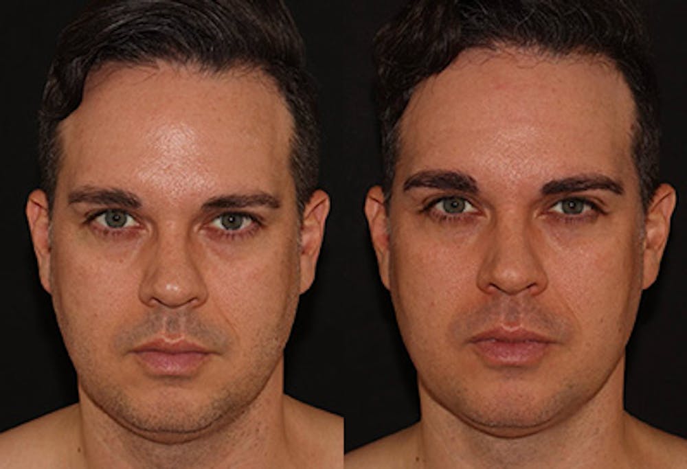 EMFACE Before & After Gallery - Patient 141184732 - Image 1