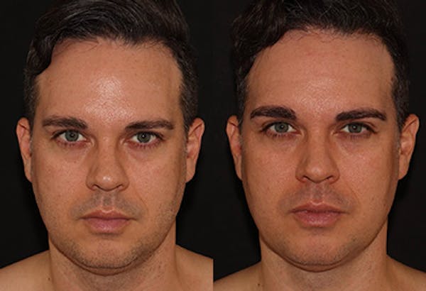 EMFACE Before & After Gallery - Patient 141184732 - Image 1