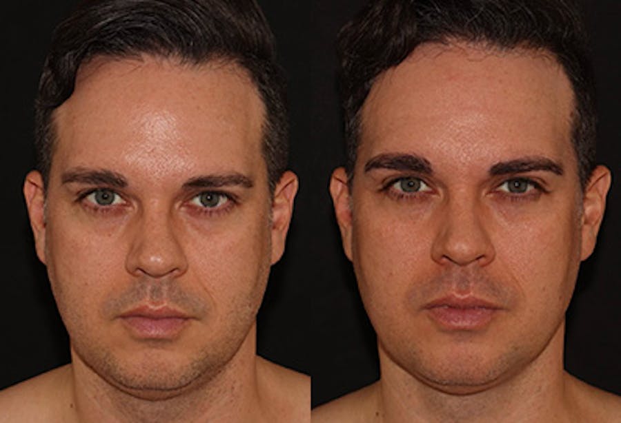 EMFACE Before & After Gallery - Patient 141184732 - Image 1