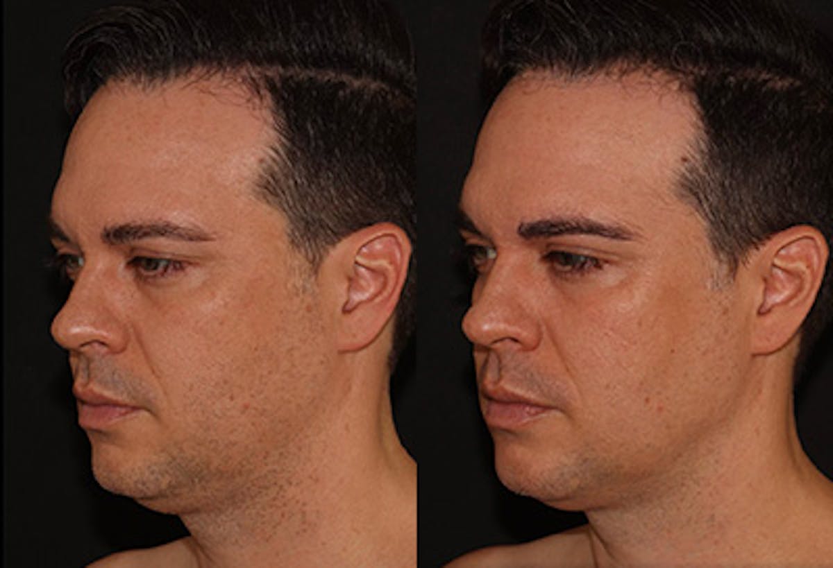 EMFACE Before & After Gallery - Patient 141184732 - Image 2