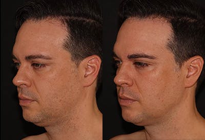 EMFACE Before & After Gallery - Patient 141184732 - Image 2