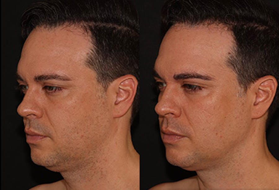 EMFACE Before & After Gallery - Patient 141184732 - Image 2