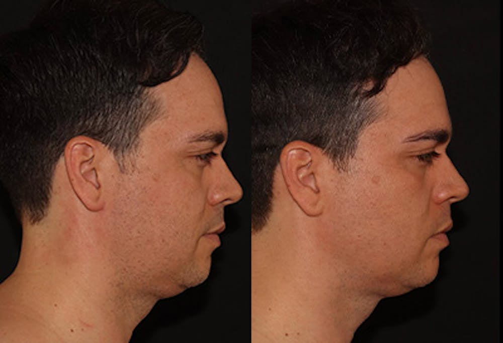 EMFACE Before & After Gallery - Patient 141184732 - Image 3