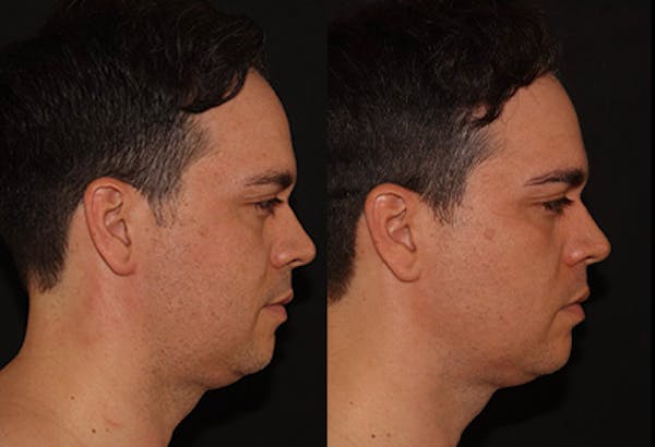 EMFACE Before & After Gallery - Patient 141184732 - Image 3