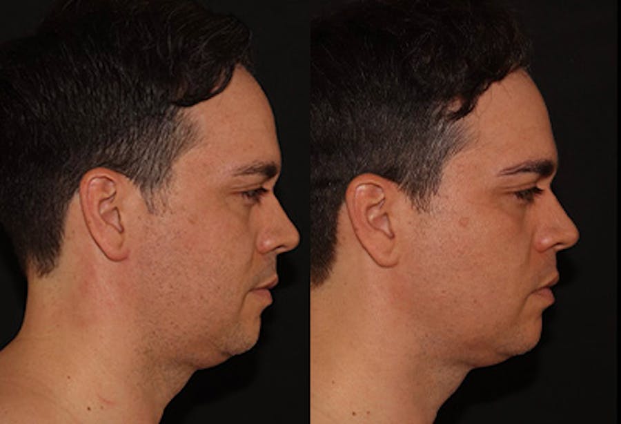 EMFACE Before & After Gallery - Patient 141184732 - Image 3