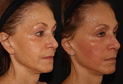 EMFACE Before & After Gallery - Patient 141184731 - Image 2