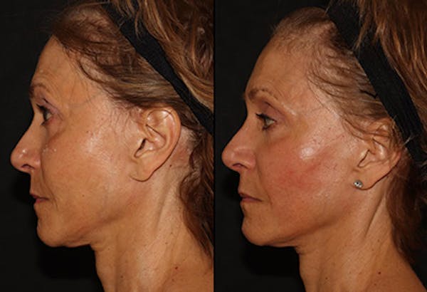EMFACE Before & After Gallery - Patient 141184731 - Image 3