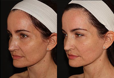 EMFACE Before & After Gallery - Patient 141184729 - Image 2