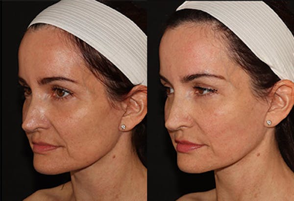 EMFACE Before & After Gallery - Patient 141184729 - Image 2