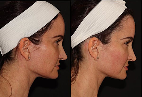 EMFACE Before & After Gallery - Patient 141184729 - Image 3