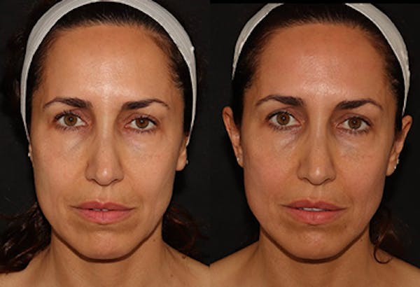 EMFACE Before & After Gallery - Patient 141184725 - Image 1