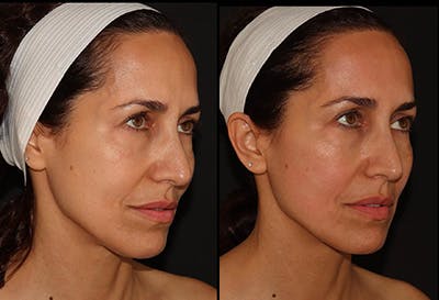 EMFACE Before & After Gallery - Patient 141184725 - Image 2