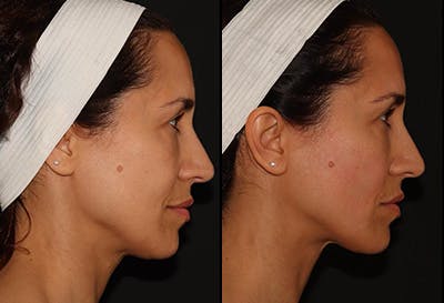 EMFACE Before & After Gallery - Patient 141184725 - Image 3