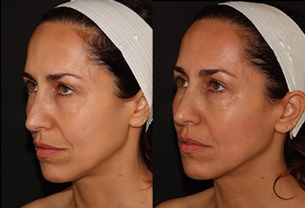 EMFACE Before & After Gallery - Patient 141184725 - Image 4