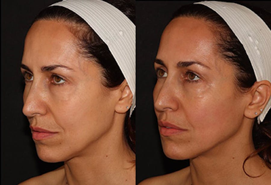 EMFACE Before & After Gallery - Patient 141184725 - Image 4