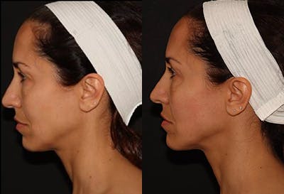 EMFACE Before & After Gallery - Patient 141184725 - Image 5