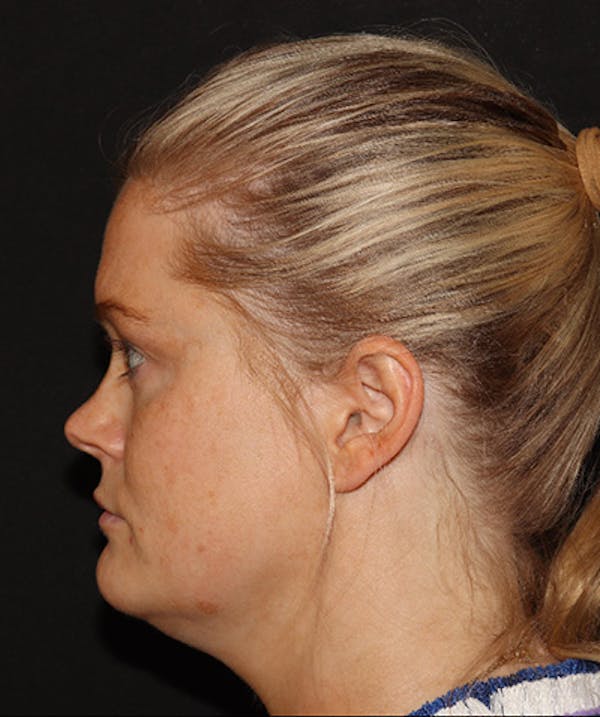 Sofwave Before & After Gallery - Patient 142880660 - Image 1