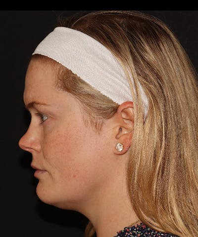 Sofwave Before & After Gallery - Patient 142880660 - Image 2